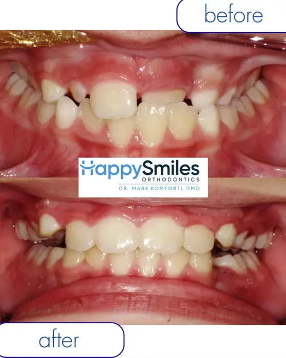 Before and after crossbite correction