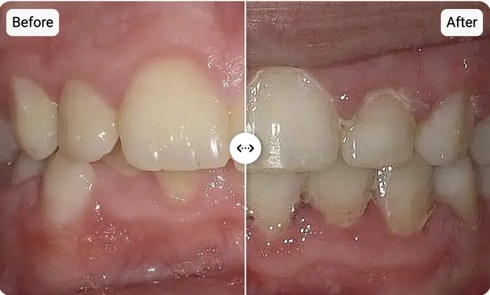Before and after crowded bite